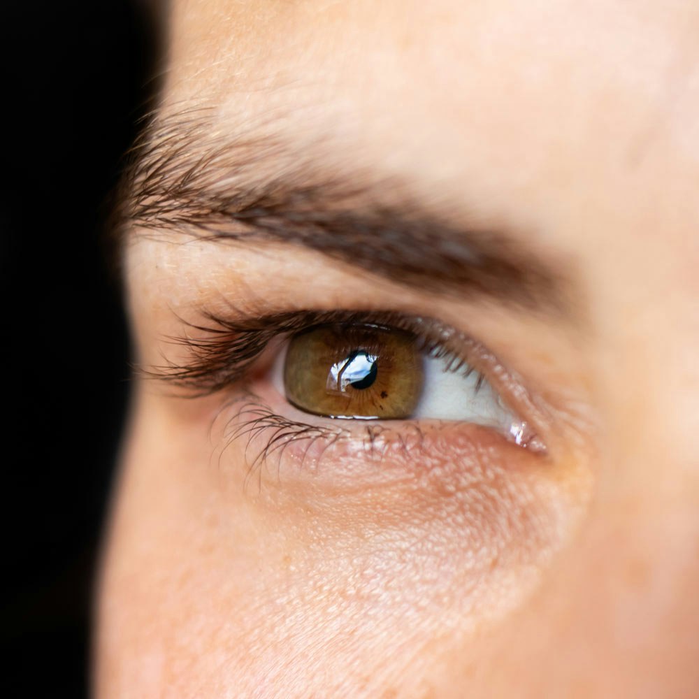 Close up of eye with need of a corneal transplant