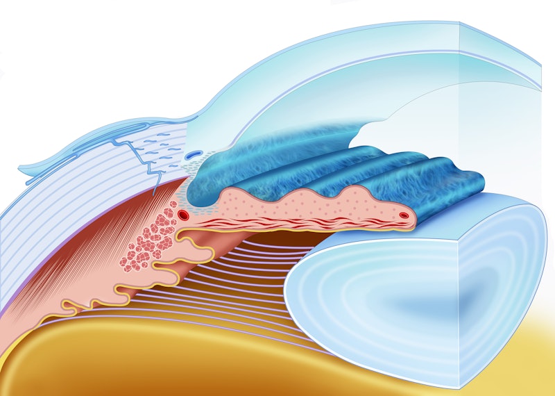 DSAEK cornea procedure