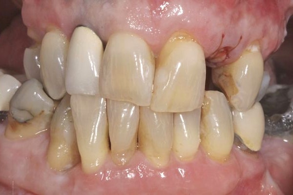 A mouth with decayed, discolored, and missing teeth