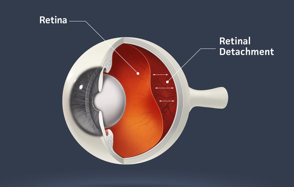 Diagram of retina and retinal detachment