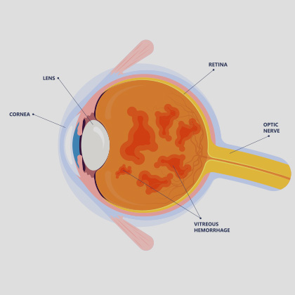 Vitreous Hemorrhage