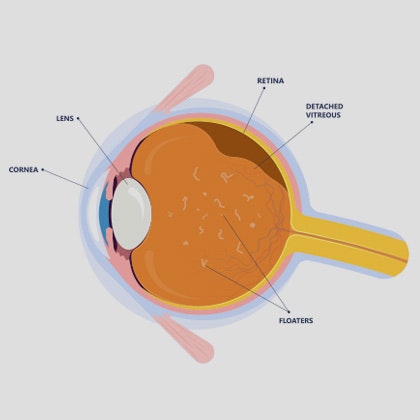 Retinal Tear or Detachment