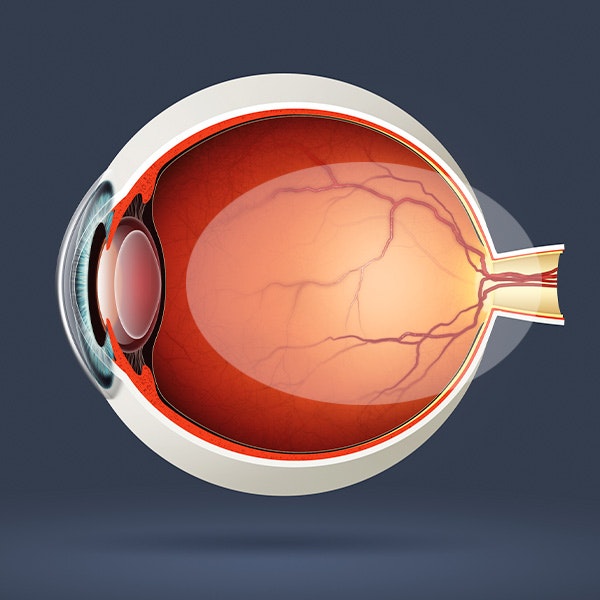 Diabetic Retinopathy