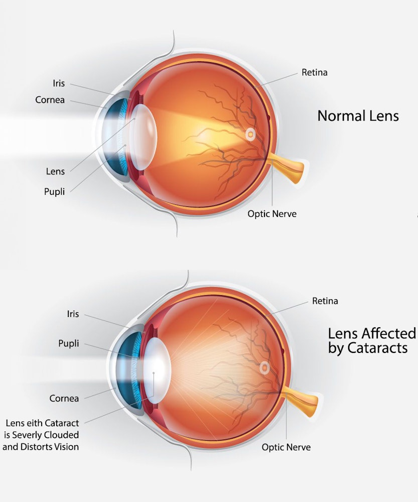 Illustration of a normal and cataract lens