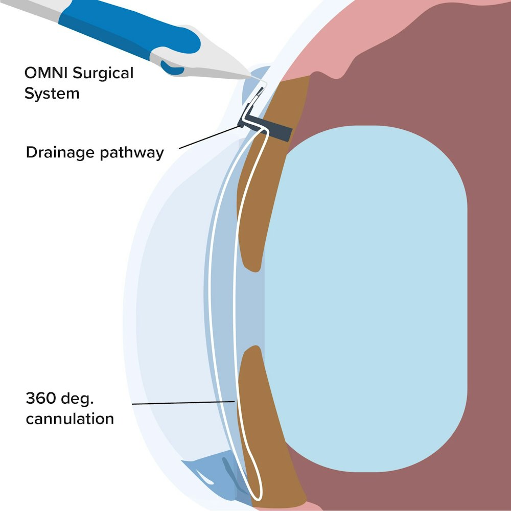 OMNI® Surgical System