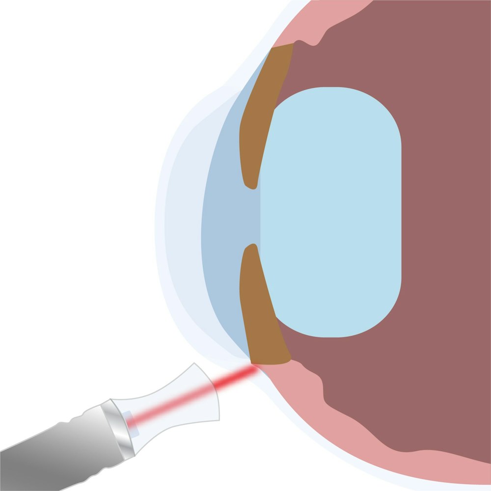 Cyclophotocoagulation