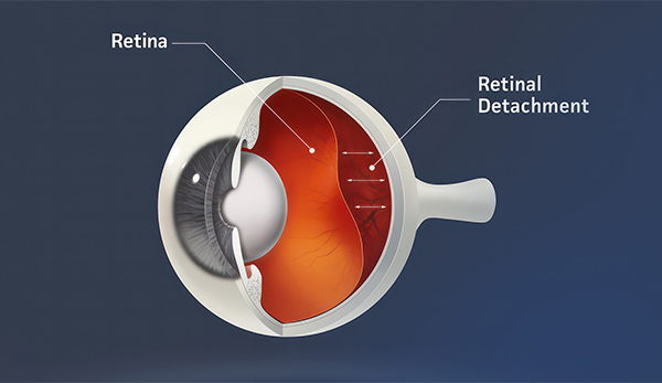 Retinal Detachment Monterey, CA - Salinas - King City - Monterey County ...