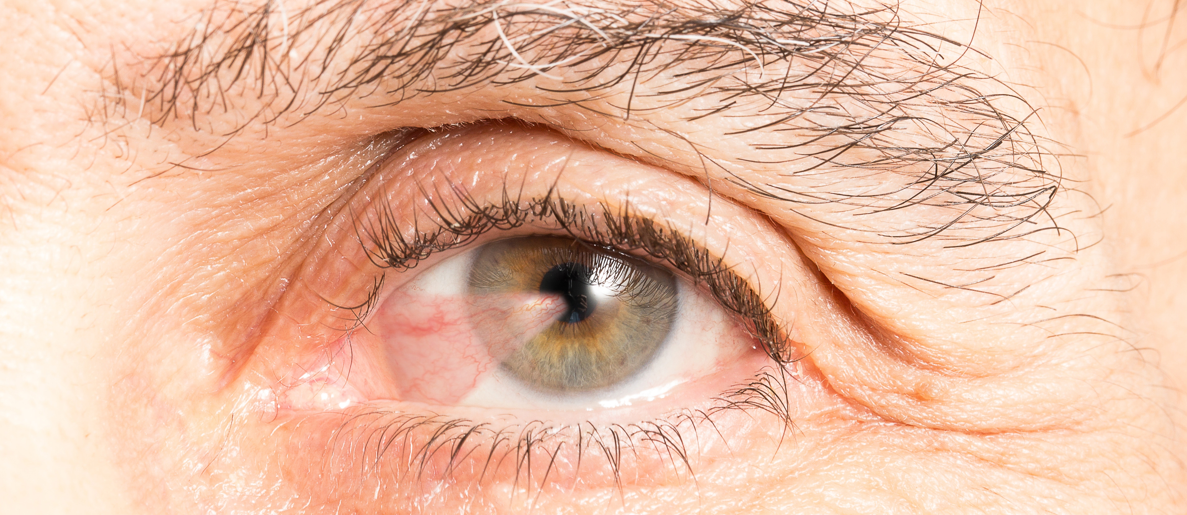close-up of pterygium