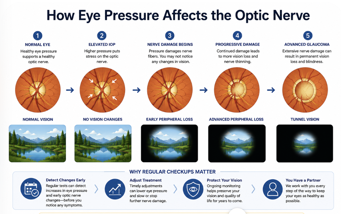 how eye pressure affects the optic nerve