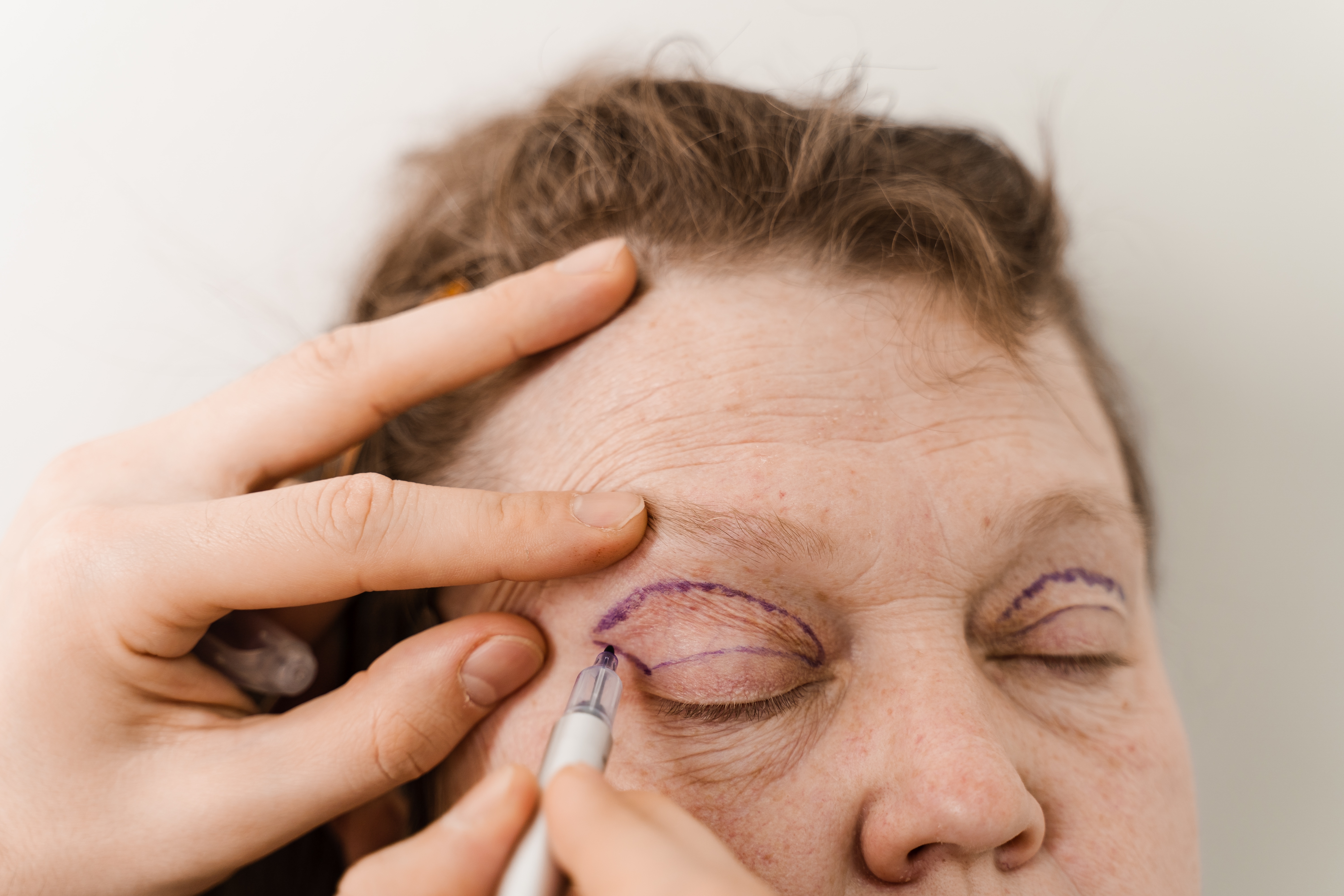 surgeon planning blepharoplasty