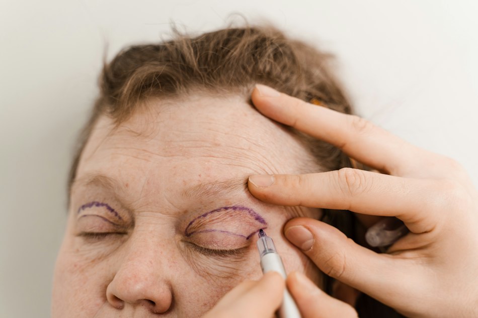 surgeon planning blepharoplasty