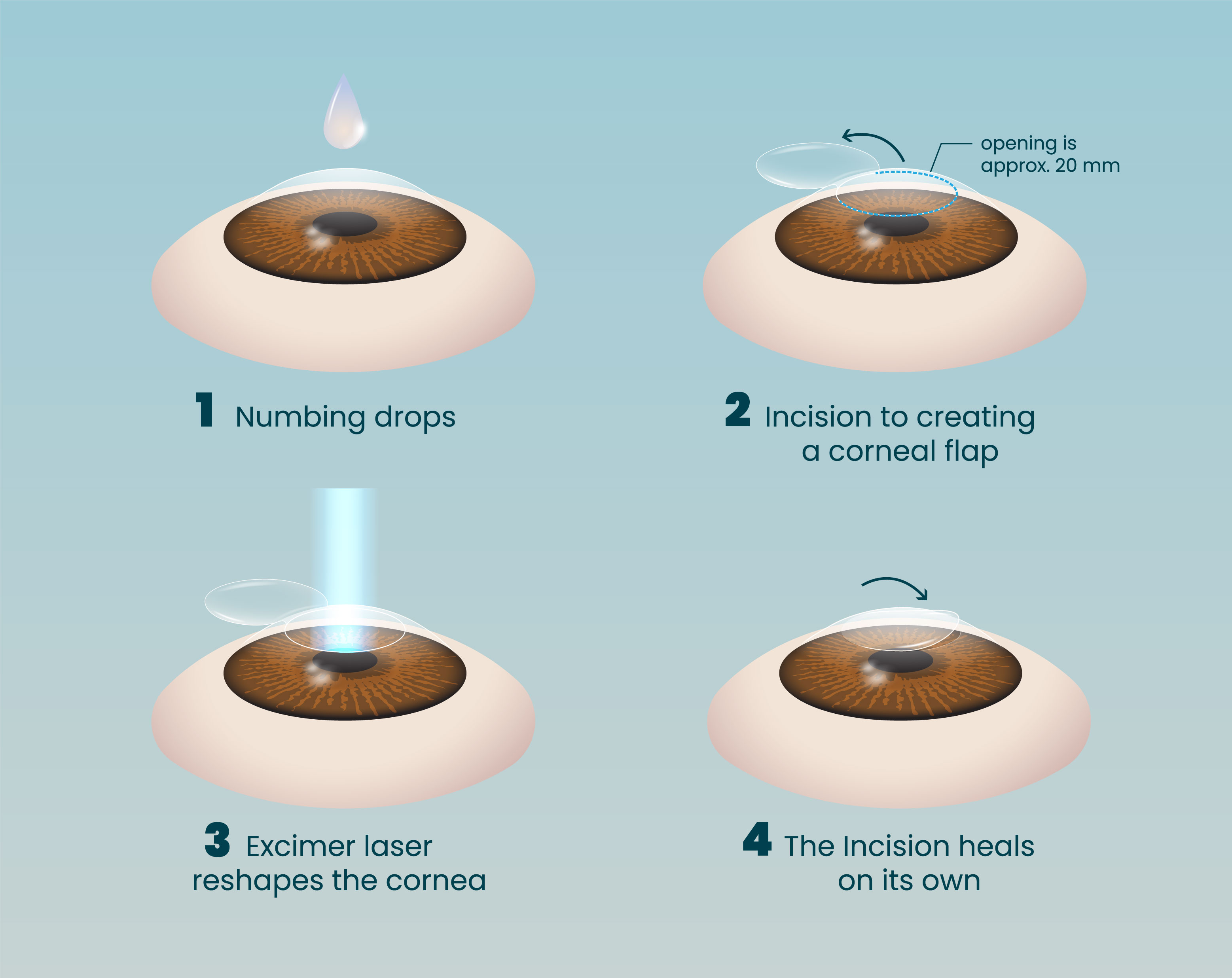 four steps of lasik surgery