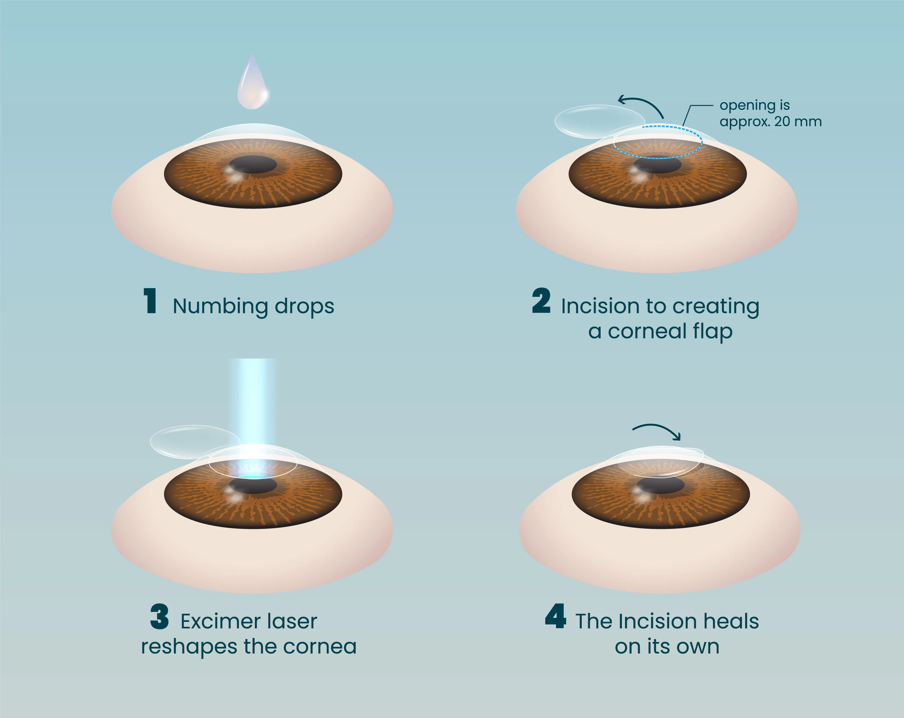 four steps of lasik surgery