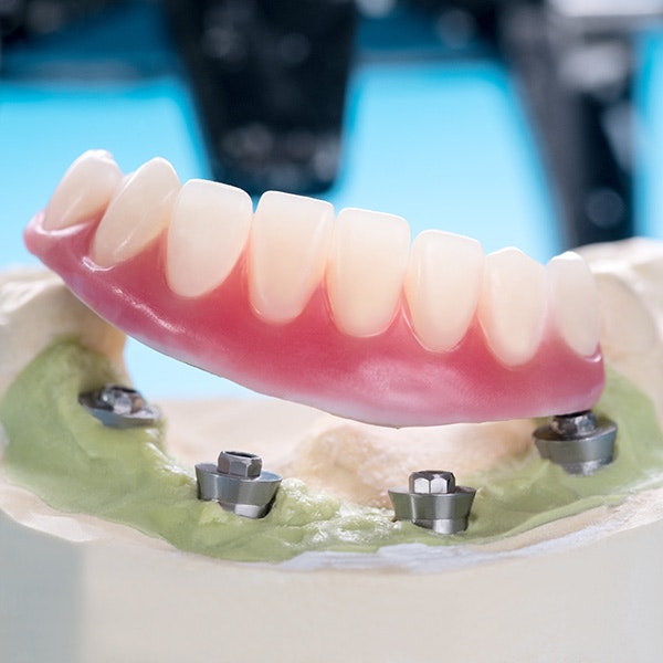 Implant supported dentures