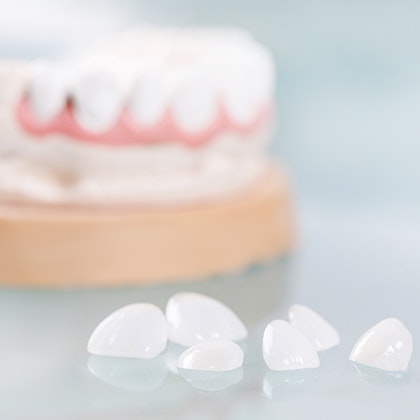 Model of teeth and veneers
