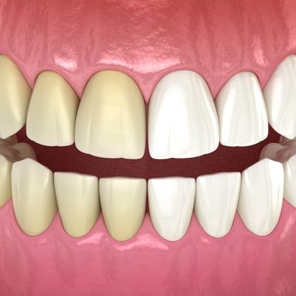 before and after whitening