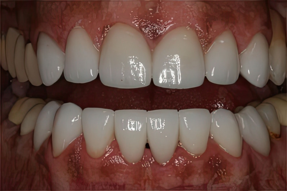 Smile Montreal patient with white teeth after veneer placement