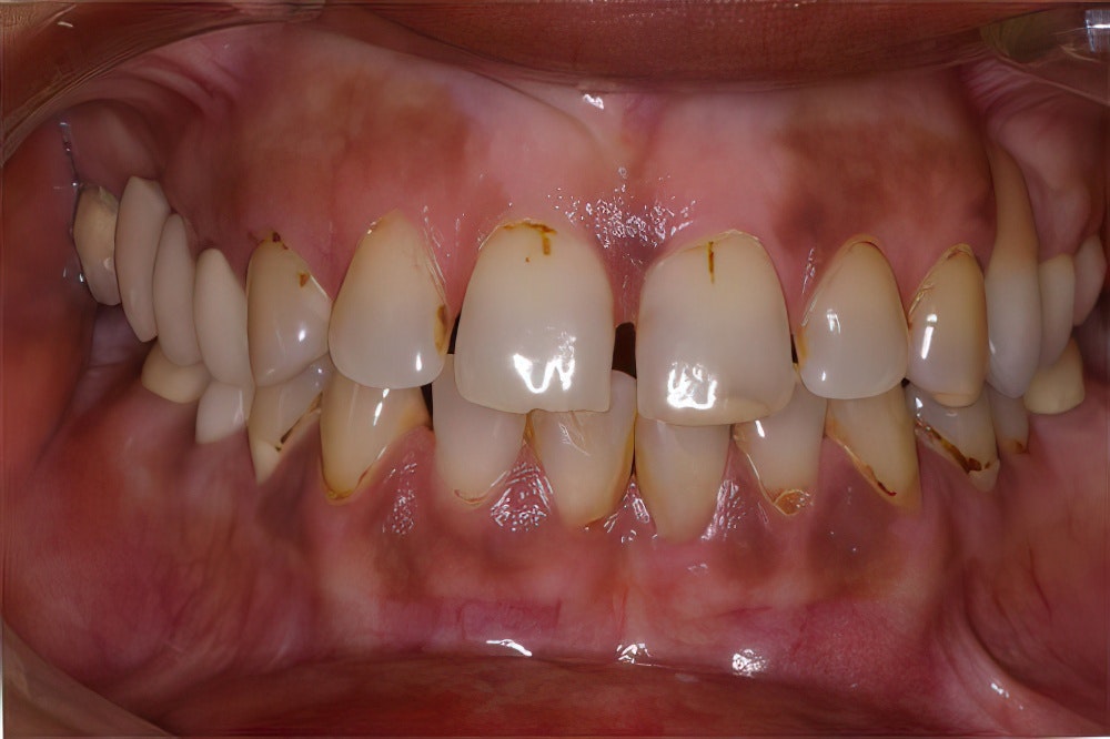Smile Montreal patient with stained teeth before cosmetic treatment