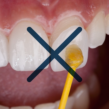 veneer being placed on a front tooth