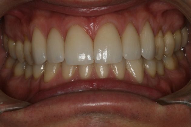 after a smile makeover