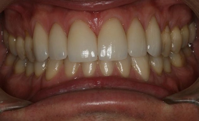 after a smile makeover