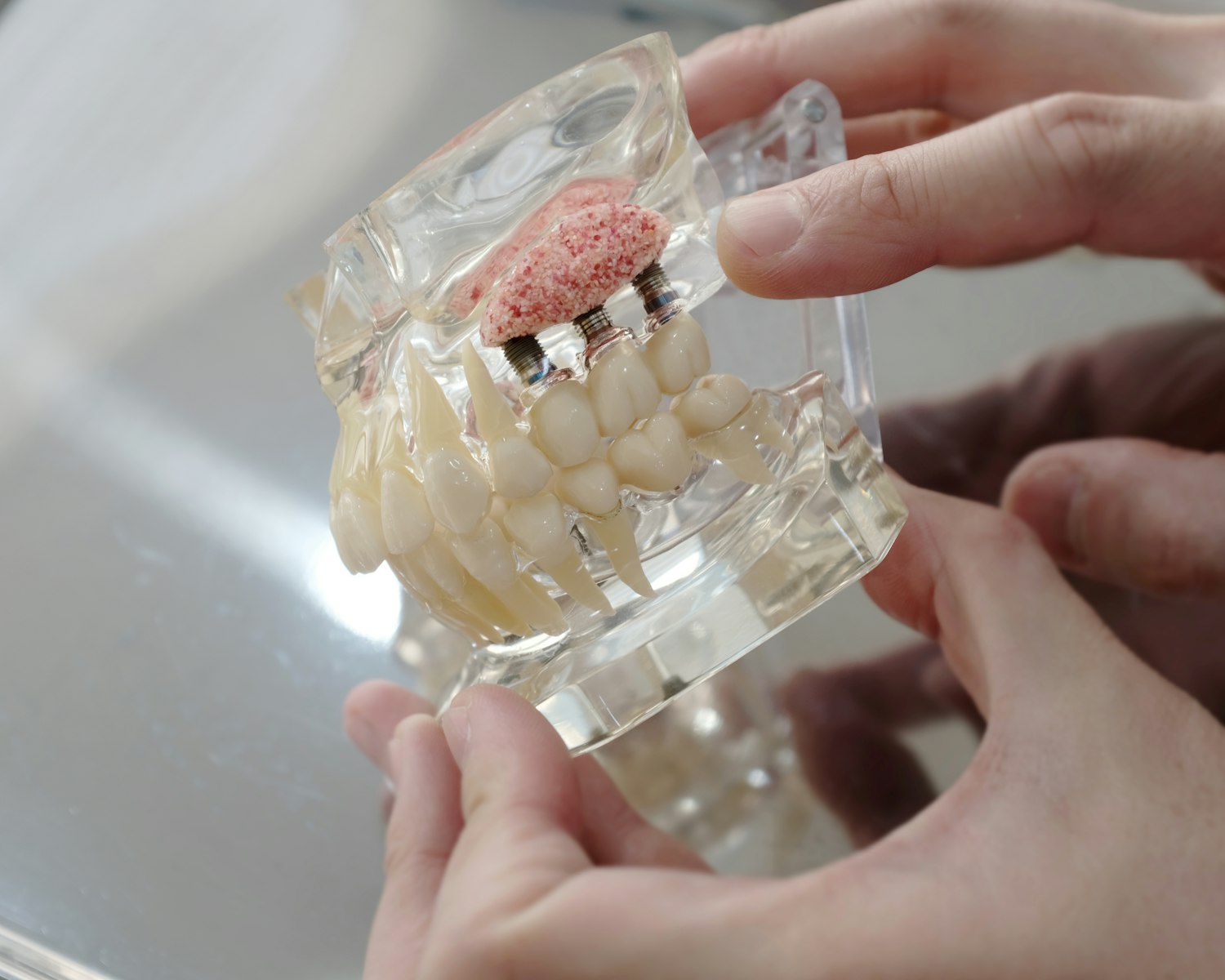 dentla model showing bone graft