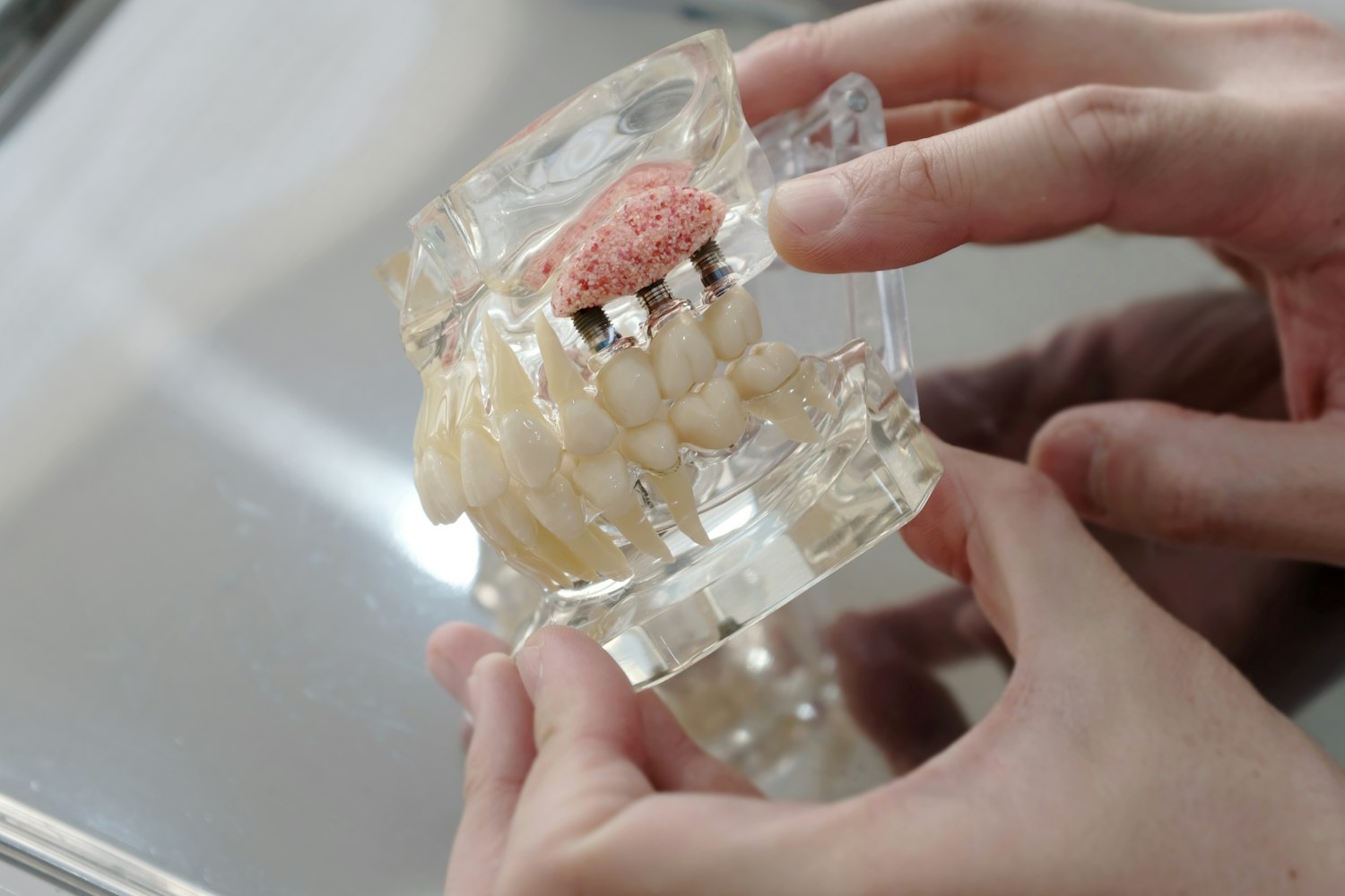 dentla model showing bone graft