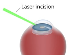 3D illustration of Laser Assisted Cataract Surgery