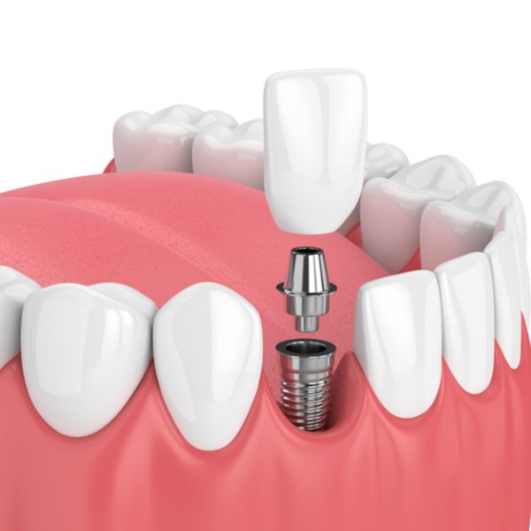 Dental implant and restoration