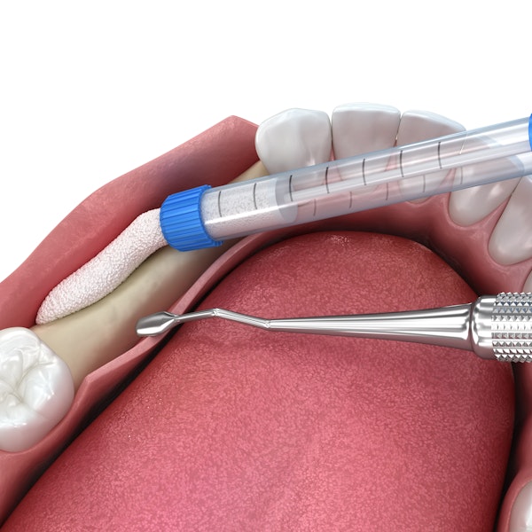 Bone grafting illustration