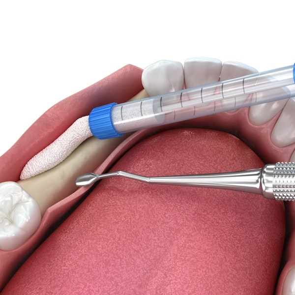 Bone grafting illustration