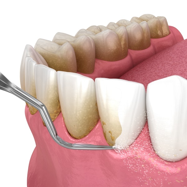Illustration of periodontal care