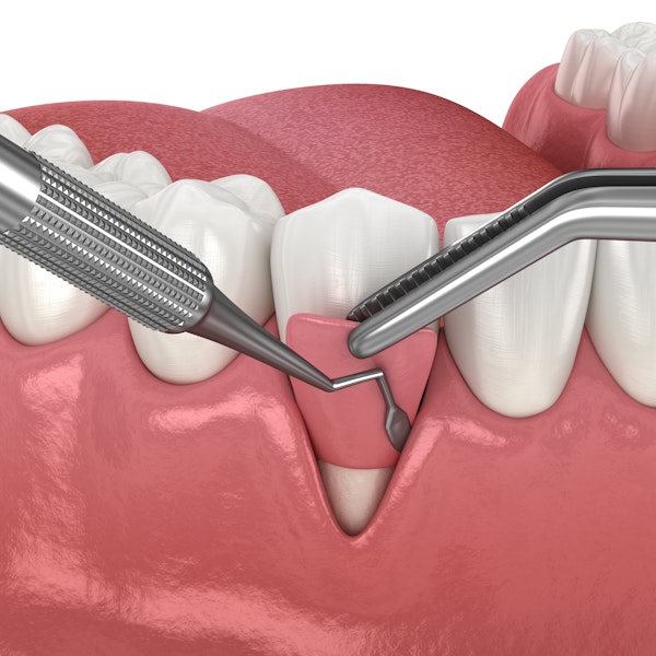 Gum grafting illustration