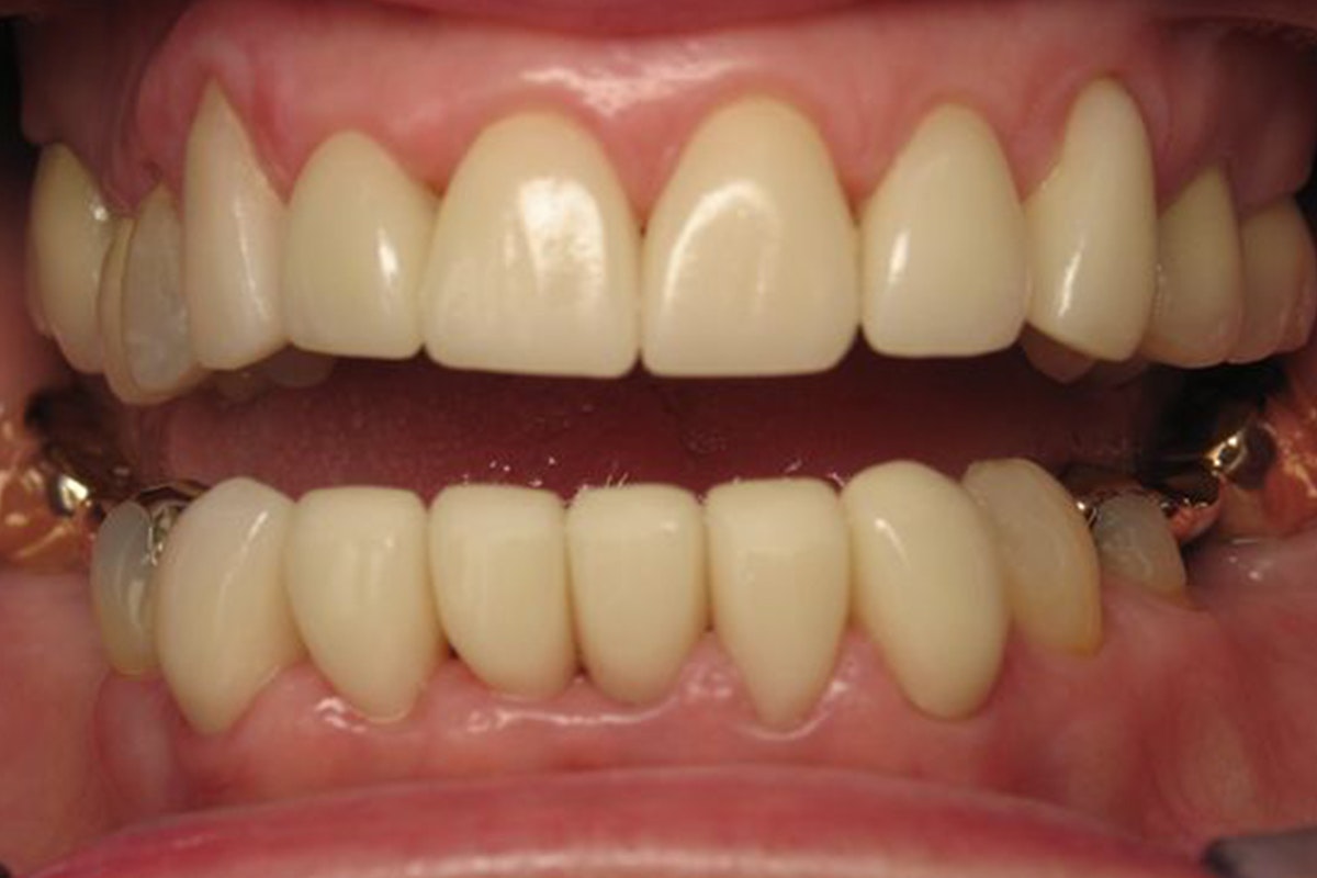 after dental crowns