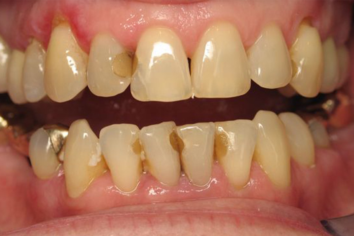 before dental crowns