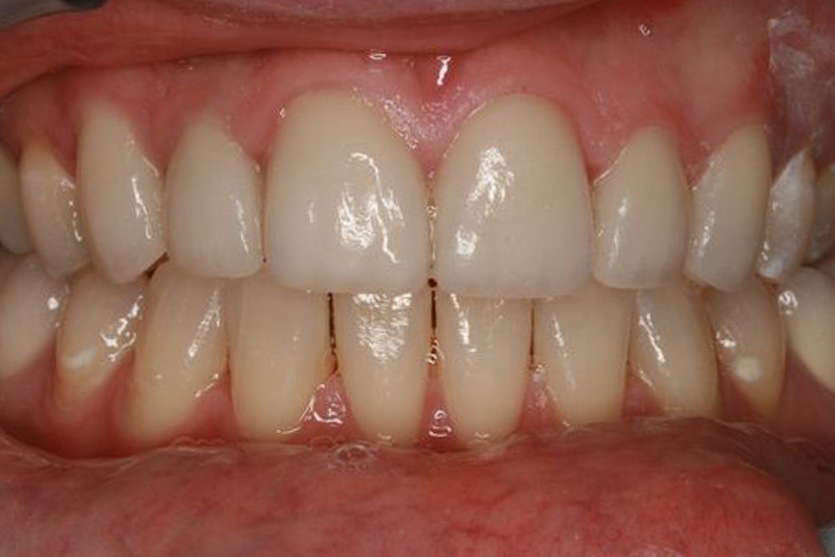 after orthodontics photo