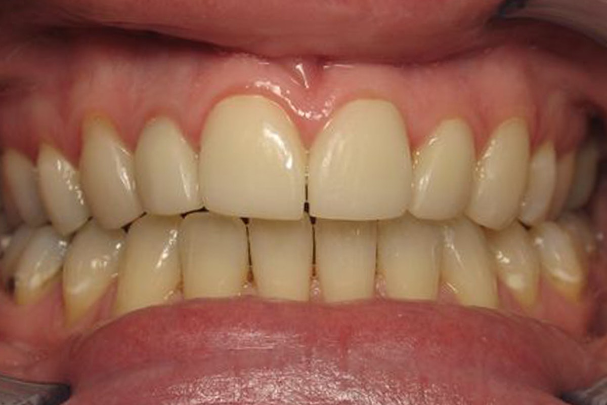 Before orthodontics photo