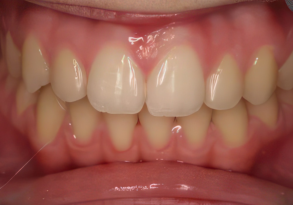 teeth after ortho