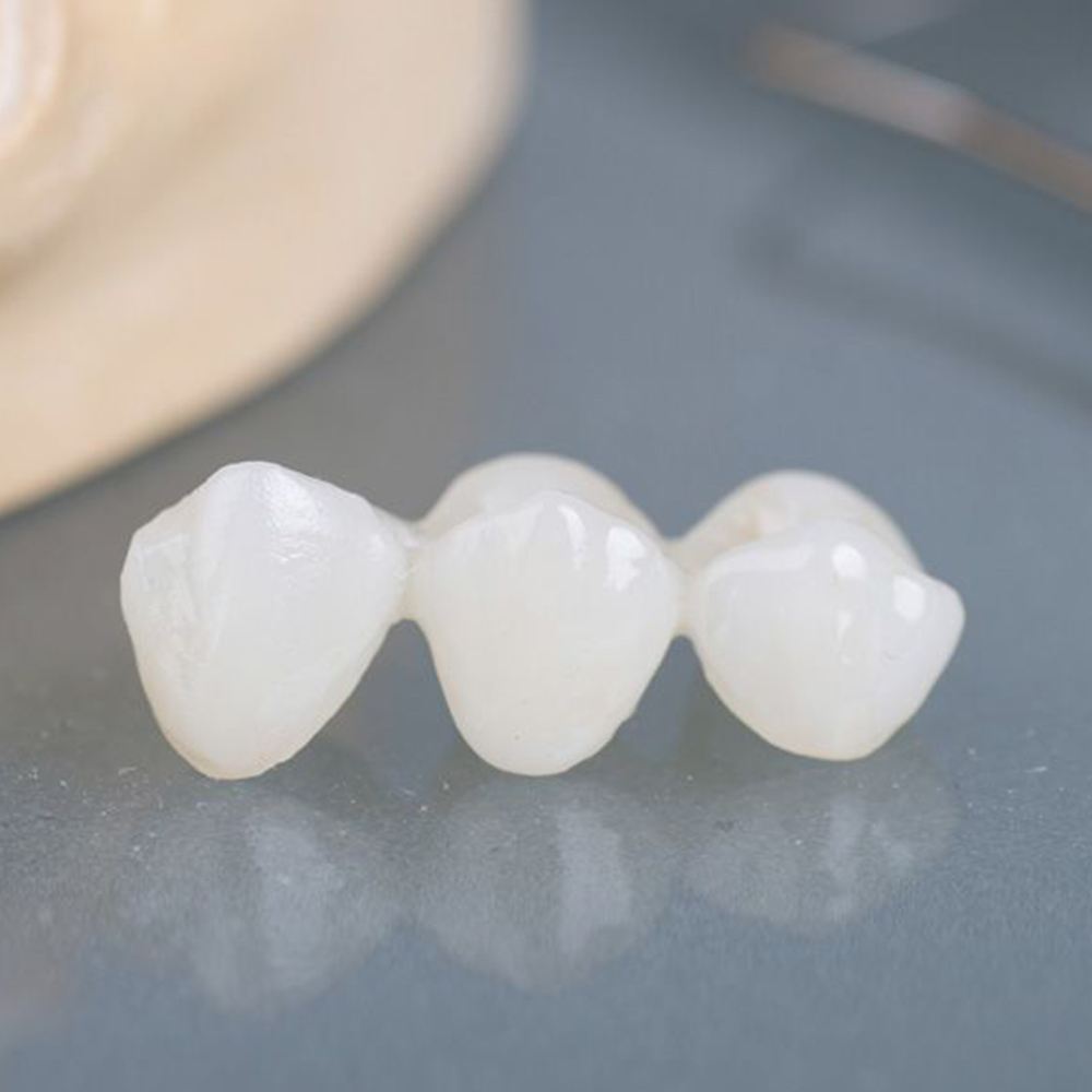 dental bridge