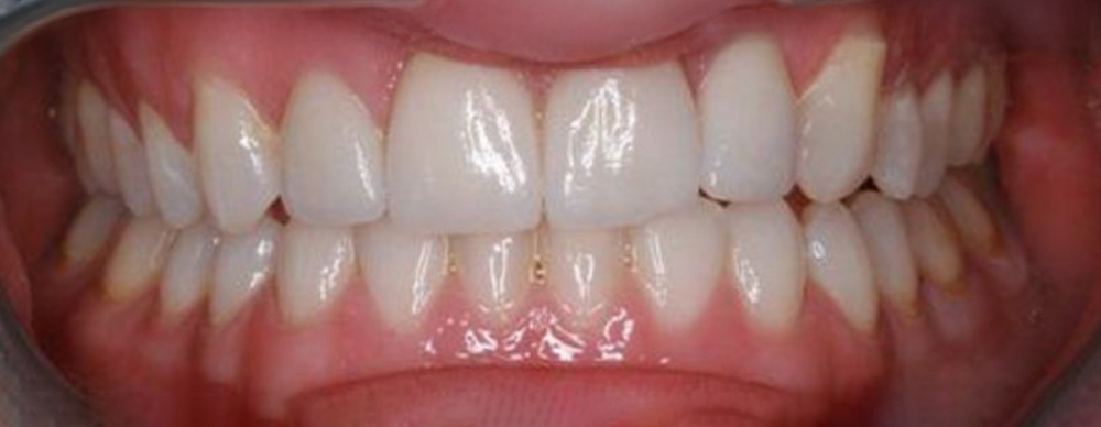 teeth after whitening