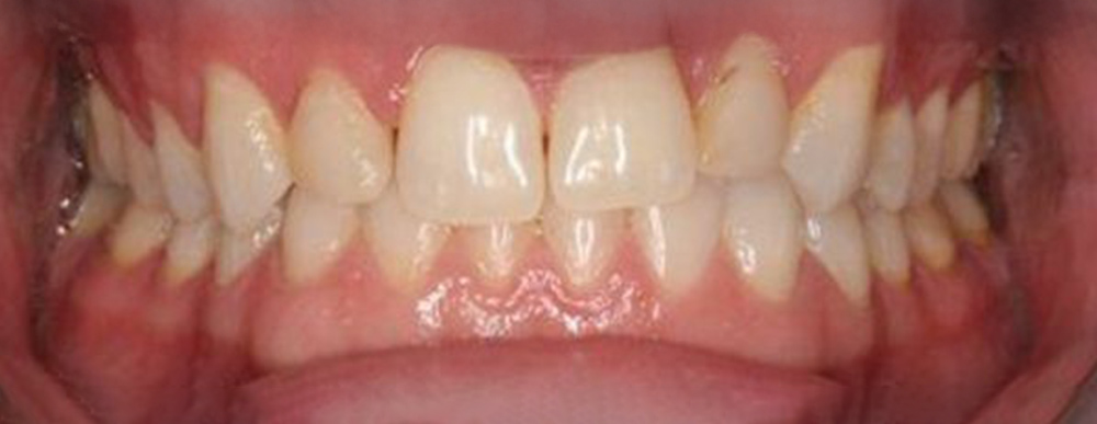 teeth before whitening
