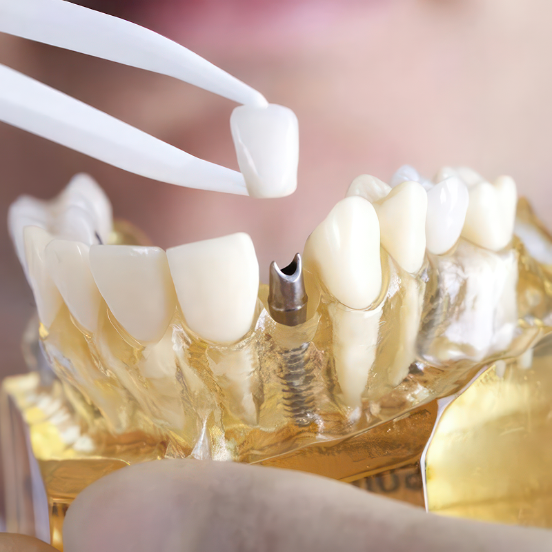 Photo of a dental implant in a mold of a jaw