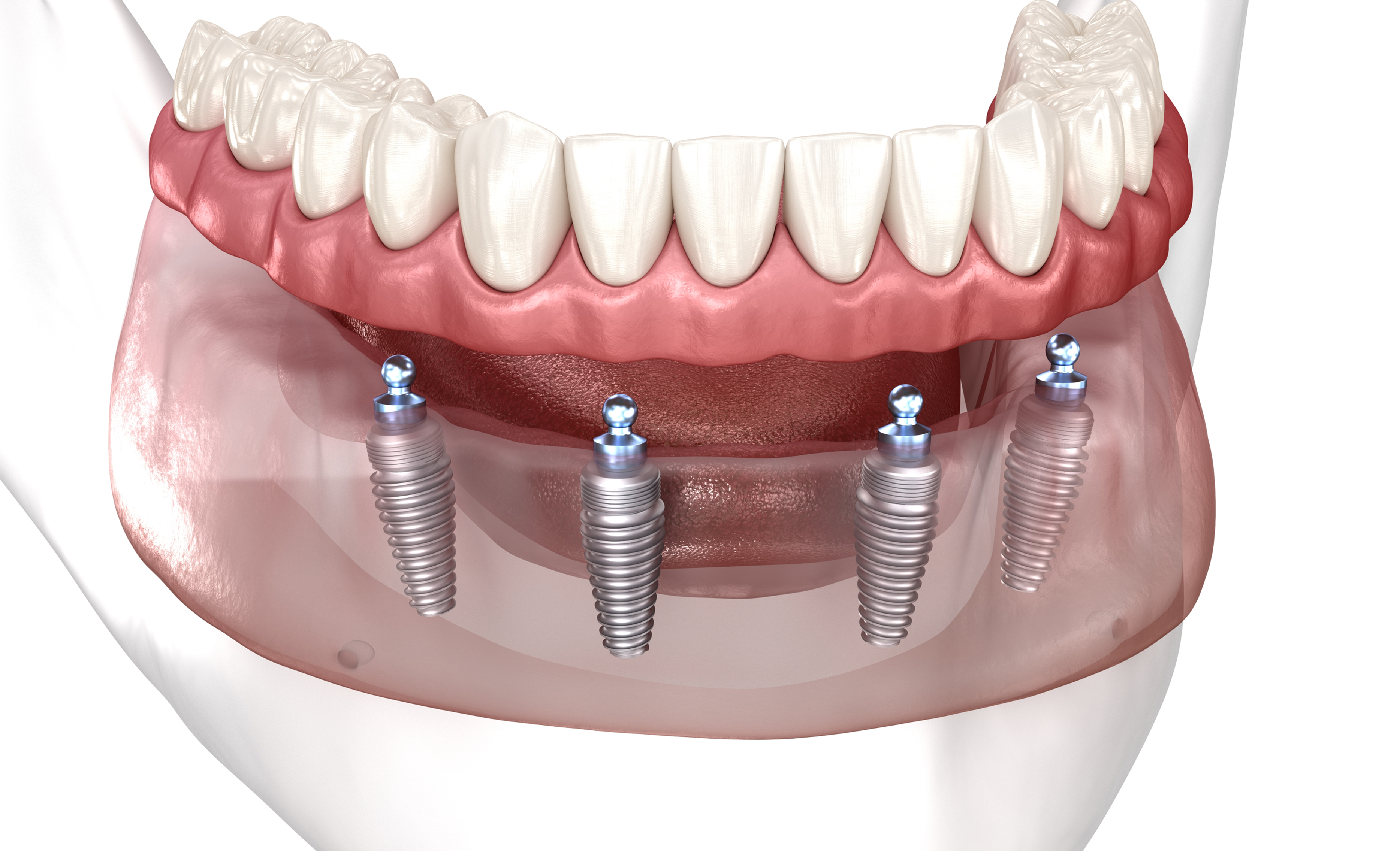 implant-supported denture