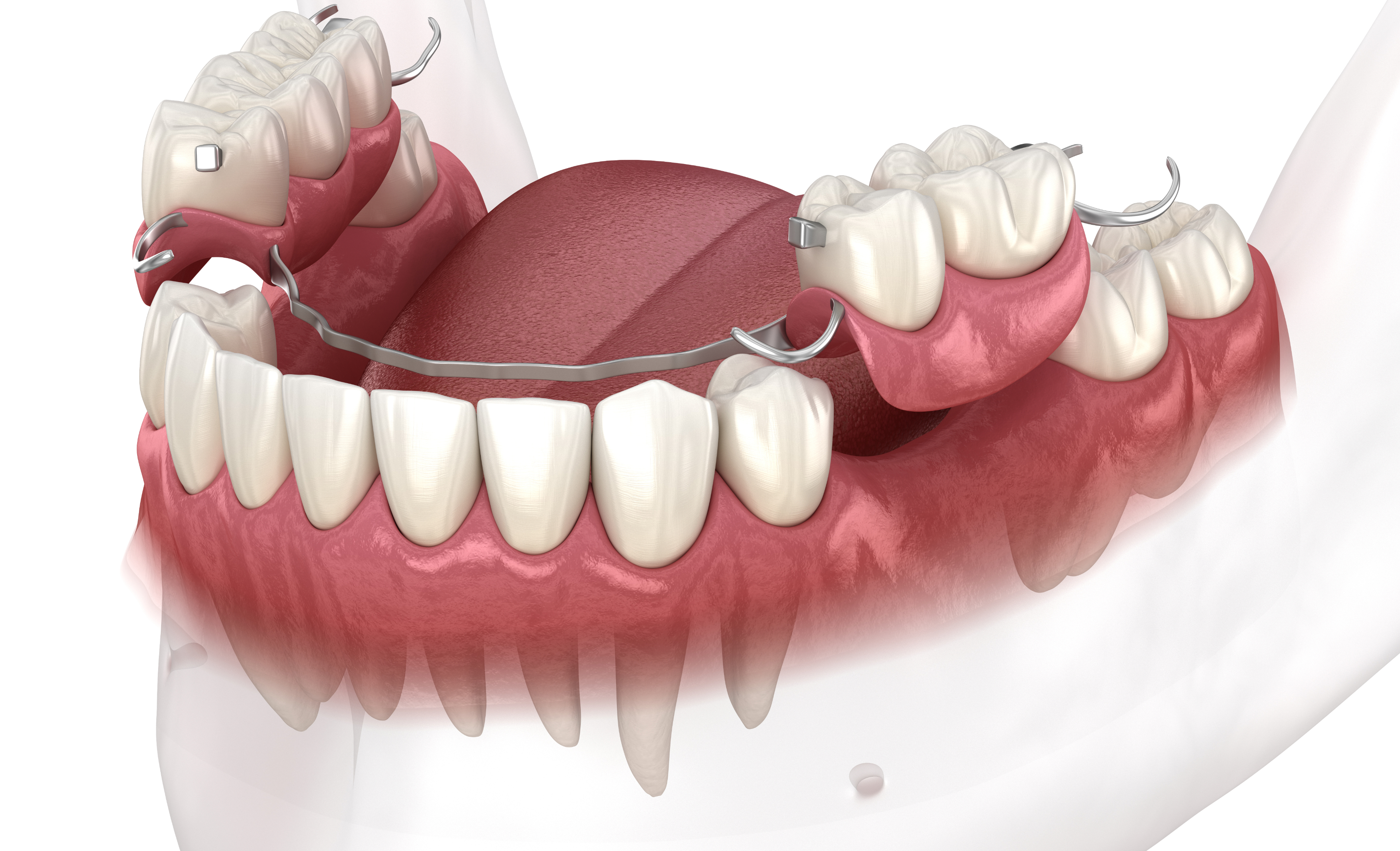 traditional partial denture