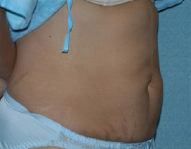 After liposuction
