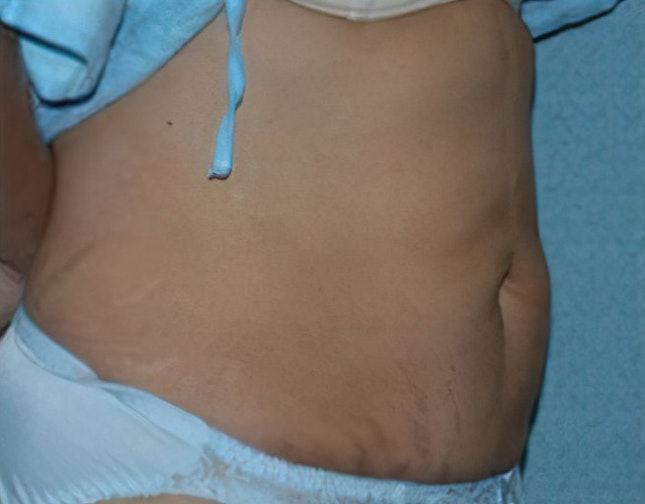 After liposuction