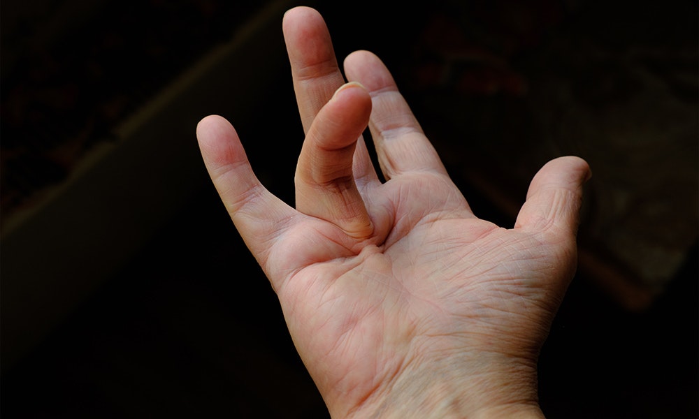 a hand with Dupuytren's Contracture