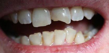 Before Cosmetic Dentistry