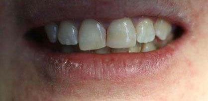 After Cosmetic Dentistry