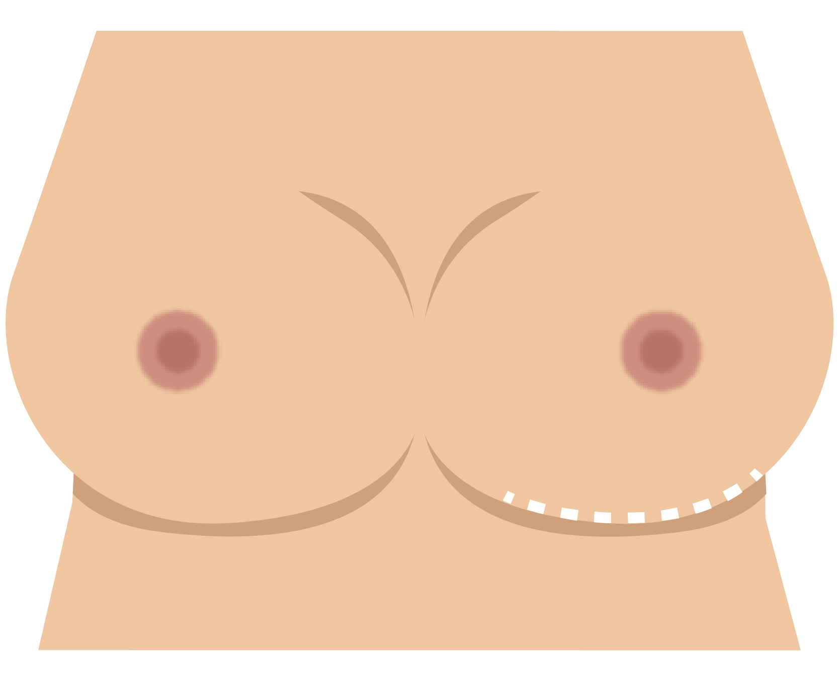 Inframammary incision pattern